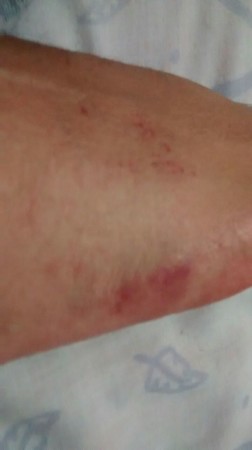 Hematomas 